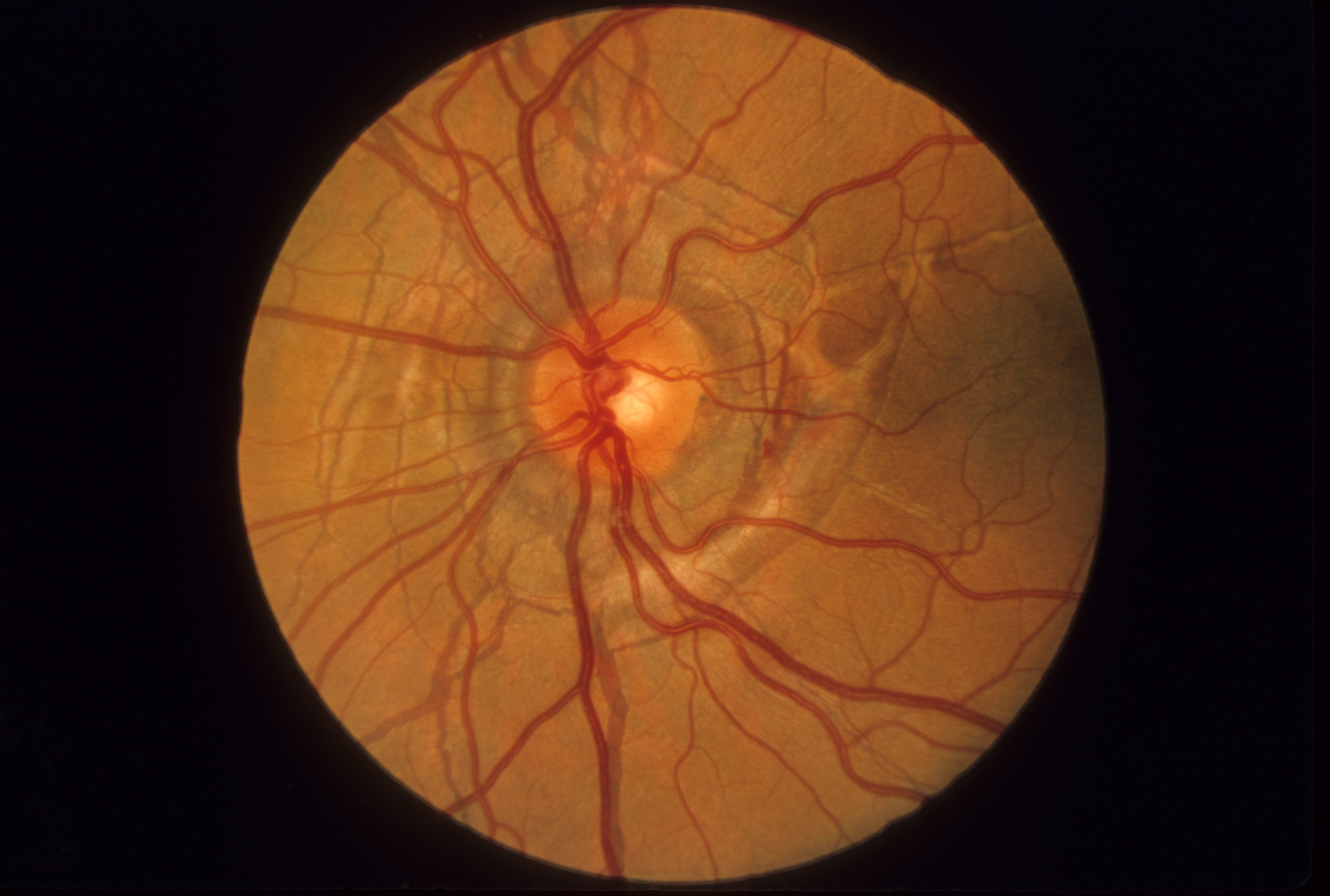 Pseudoxanthoma Elasticum Hereditary Ocular Diseases 9259